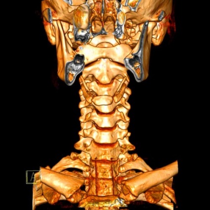 A komputertomográfia a nyaki gerinc, CT területe nyakcsigolyák