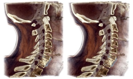A komputertomográfia a nyaki gerinc, CT területe nyakcsigolyák