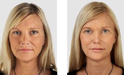 Alaki plasztika Face - jelzések, technikák, vélemények, fotók és videó (Contour arc töltőanyagok, hialuronsav szálak) Alaki plasztika Face - jelzések, technikák, áttekintésre, képek és videó