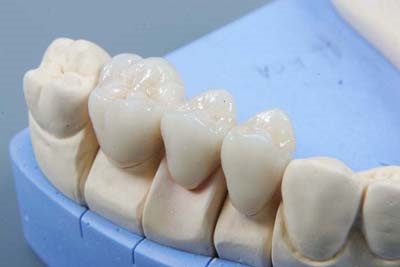 Koronák fogászati ​​implantátumok típusú, amelyben az árak, a termelés