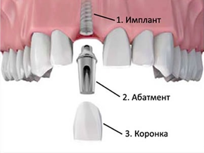 Koronák fogászati ​​implantátumok típusú, amelyben az árak, a termelés