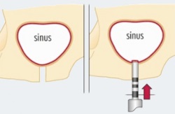 Csontpótlás - sinus lift, klinika nordimplant