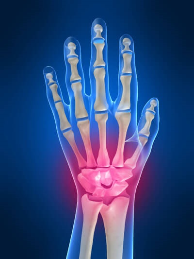 Arthritis Csuklóízület készítmények és kezelési népi jogorvoslati