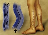 Foot masszírozó ellenjavallatok (használat masszírozó szükséges) Foot masszírozó ellenjavallatok
