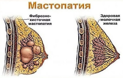 Mastodinon a tőgygyulladás, hogyan kell a gyógyszert a tabletták és cseppek