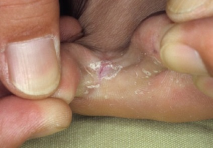 Dermofiliya ujjak láb - tünetek és kezelés