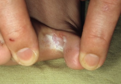 Dermofiliya ujjak láb - tünetek és kezelés