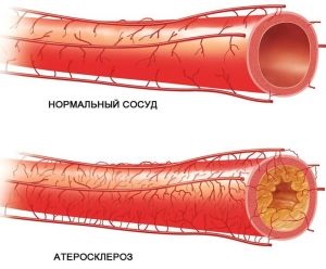 Multifokális atherosclerosis, annak okait és tünetei