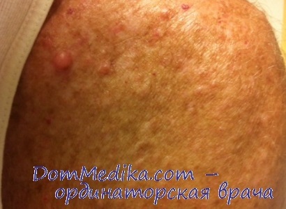 Neurofibromatózis okai, típusai, diagnózis és kezelés (diagnózis neurofibromatózis) Neurofibromatózis okai, típusai, diagnózisa, kezelése
