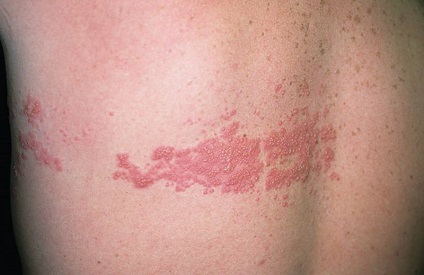 Az övsömör fertőző vagy nem mások (herpes zoster fertőzés) Az övsömör fertőző vagy nem mások