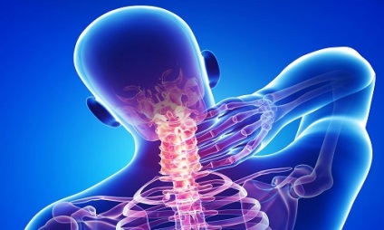 Osteophytes a nyaki gerinc, mi az, hogy hogyan lehet megszabadulni (nyaki) Osteophytes a nyaki gerinc, mi az, hogy hogyan lehet megszabadulni