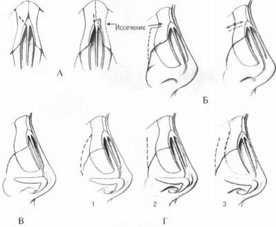 Osteotomia csont nazális piramis (orr) Osteotomia csont nazális piramis