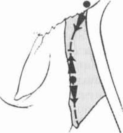Osteotomia csont nazális piramis (a csontok az orr piramis) Osteotomia csont nazális piramis