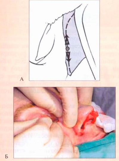 Osteotomia csont nazális piramis (osteotomia) Osteotomia csont nazális piramis