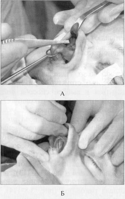 Osteotomia csont nazális piramis (orr) Osteotomia csont nazális piramis