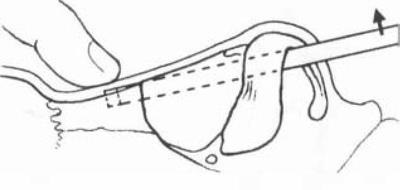 Osteotomia csont nazális piramis (orr) Osteotomia csont nazális piramis