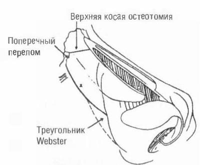 Osteotomia csont nazális piramis (orr) Osteotomia csont nazális piramis