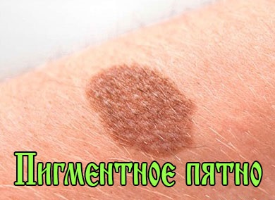 Bőrvilágosító három százalék hidrogén-peroxidot -, hogyan kell eltávolítani Pigment foltok kezelésére