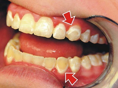Tooth Whitening a fluorózist és eltávolítása után a merevítések hogy vybelivat a fogszuvasodás, világitó (fogak fehérítésére protézis) Fehérítése fogak fluorosis és eltávolítása után a merevítések hogy vybelivat a fogszuvasodás, a pontosítás
