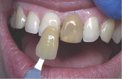Fehérítése fogak fluorosis és eltávolítása után a merevítések hogy vybelivat a fogszuvasodás, a pontosítás