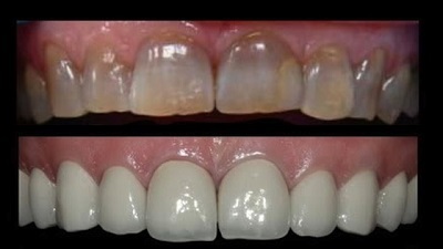 Tooth Whitening a fluorózist és eltávolítása után a merevítések hogy vybelivat a fogszuvasodás, világitó (fehérítés tetraciklin-foltos fogak) Fehérítése fogak fluorosis és eltávolítása után a merevítések hogy vybelivat a fogszuvasodás, a pontosítás