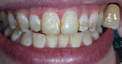 Tooth Whitening a fluorózist és eltávolítása után a merevítések hogy vybelivat a fogszuvasodás, világitó (fehérítés fogak fluorózist) Fehérítése fogak fluorosis és eltávolítása után a merevítések hogy vybelivat a fogszuvasodás, a pontosítás