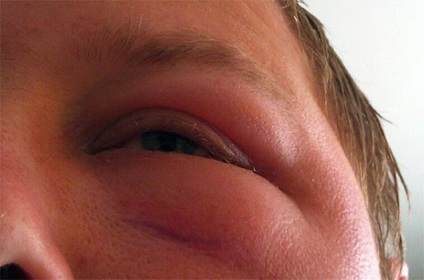 Az arc allergiás - okai, tünetei és kezelése
