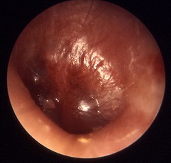 Középfülgyulladás - okai, tünetei, diagnózisa és kezelése