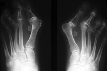 Plano-valgus láb a gyermek és a felnőtt forma okait, a kezelés (láb) Plano-valgus láb a gyermek és a felnőtt forma okait, a kezelés
