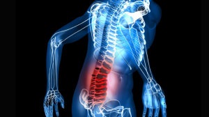 Miért van egy gerinc csontvelő ödéma fő oka és kezelése