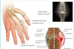 Arthritis ujjak tünetei és kezelése kezek
