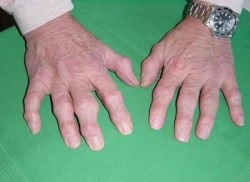 Arthritis okok, tünetek és a kezelés