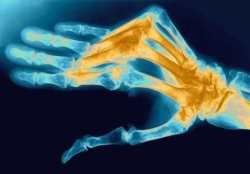 Arthritis okok, tünetek és a kezelés