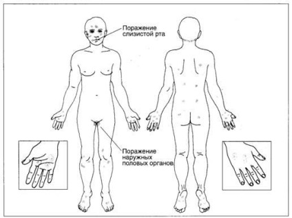 A polimorf erythema polimorf erythema