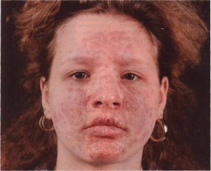 A polimorf erythema polimorf erythema