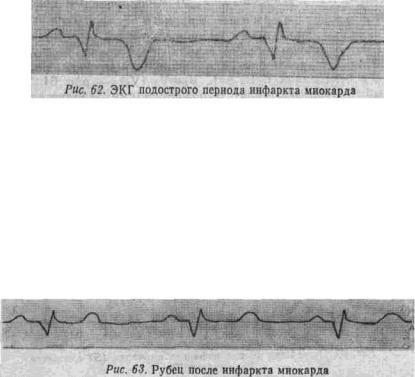 Kézi EKG (tankönyv) - dekódolását EKG (egyik ága a bal koszorúér) Kézi EKG (tankönyv) - dekódolása EKG