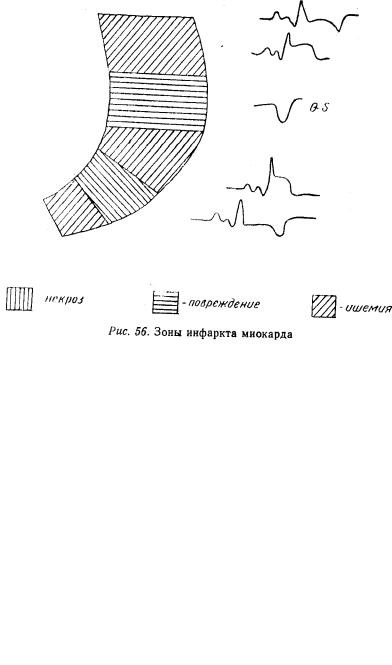 Kézi EKG (tankönyv) - dekódolása EKG (szívinfarktus érint) Kézi EKG (tankönyv) - dekódolása EKG