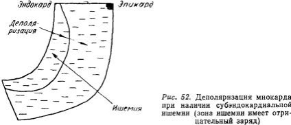 Kézi EKG (tankönyv) - dekódolása EKG (szívinfarktus érint) Kézi EKG (tankönyv) - dekódolása EKG
