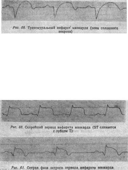 Kézi EKG (tankönyv) - dekódolása EKG (sinus) Kézi EKG (tankönyv) - dekódolása EKG