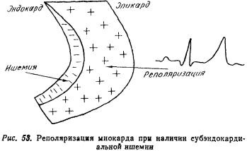 Kézi EKG (tankönyv) - dekódolását EKG (egyik ága a bal koszorúér) Kézi EKG (tankönyv) - dekódolása EKG
