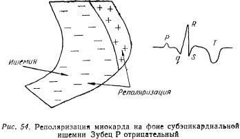 Kézi EKG (tankönyv) - dekódolása EKG (diagnózis miokardiális infarktus) Kézi EKG (tankönyv) - dekódolása EKG