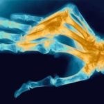 Okai és az izületi gyulladások kezelésére kezek - tünetek és patológia fotó
