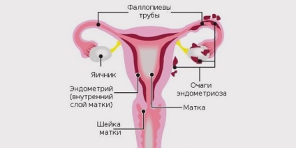 Az endometriózis tünetei tünetei, diagnózisa és osztályozása betegség