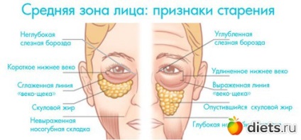 Öregedés jeleit arc középső zónában, ahol vannak - táskák - a szem alatti és az arcon ráncok