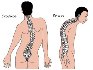 Nyaki kyphosis (hyphotikus deformitás)