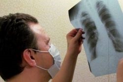 tuberculosis csontok