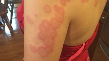 Bites bogarak (treat harap bogarak) poloska csípése