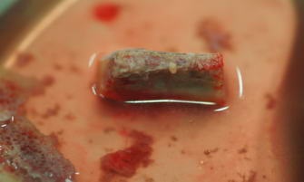Függőleges augmentáció 3d a felső és alsó állkapocs előkészítése érdekében a fogászati implantáció (pofák) Függőleges augmentáció 3d a felső és alsó állkapocs előkészítése érdekében a fogászati implantáció