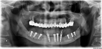 Függőleges augmentáció 3d a felső és alsó állkapocs annak érdekében, hogy előkészítse a fogászati implantátum (fogászati) Függőleges augmentáció 3d a felső és alsó állkapocs előkészítése érdekében a fogászati implantáció