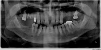 Függőleges augmentáció 3d a felső és alsó állkapocs előkészítése érdekében a fogászati ​​implantáció